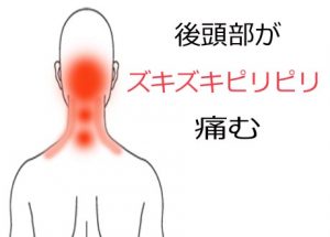 頭痛の症例 北海道札幌市東区の亮鍼灸院