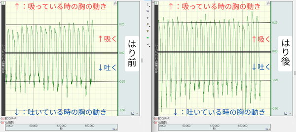 鍼治療前後の呼吸グラフ