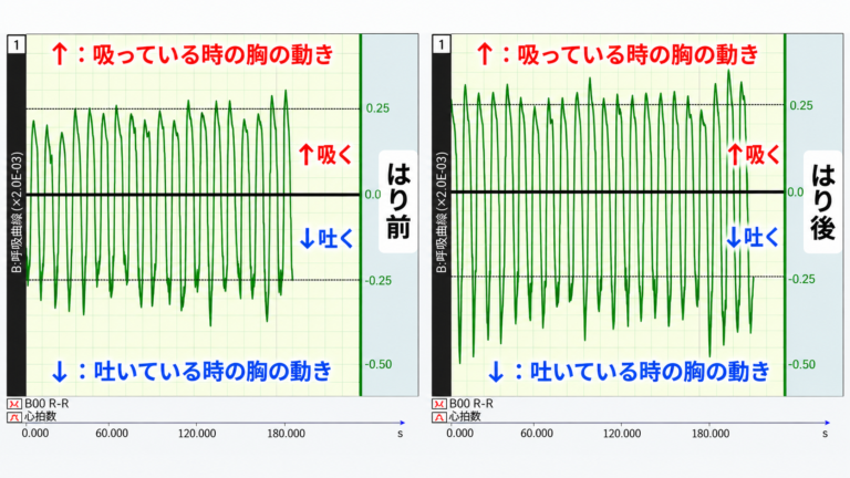 はり施術の前と後の呼吸曲線の比較。施術後は吸う・吐くの胸の動きの幅が大きくなっている(測定記録の一例)